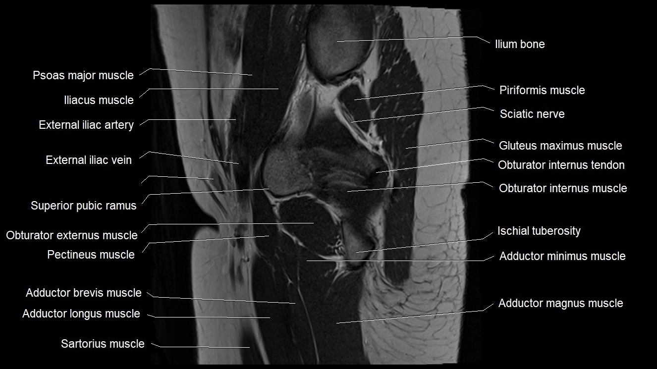 Hip sagittal cross sectional anatomy image 25.webp